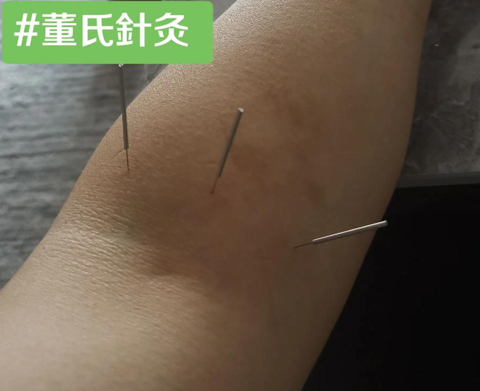 董氏针灸72绝针图片