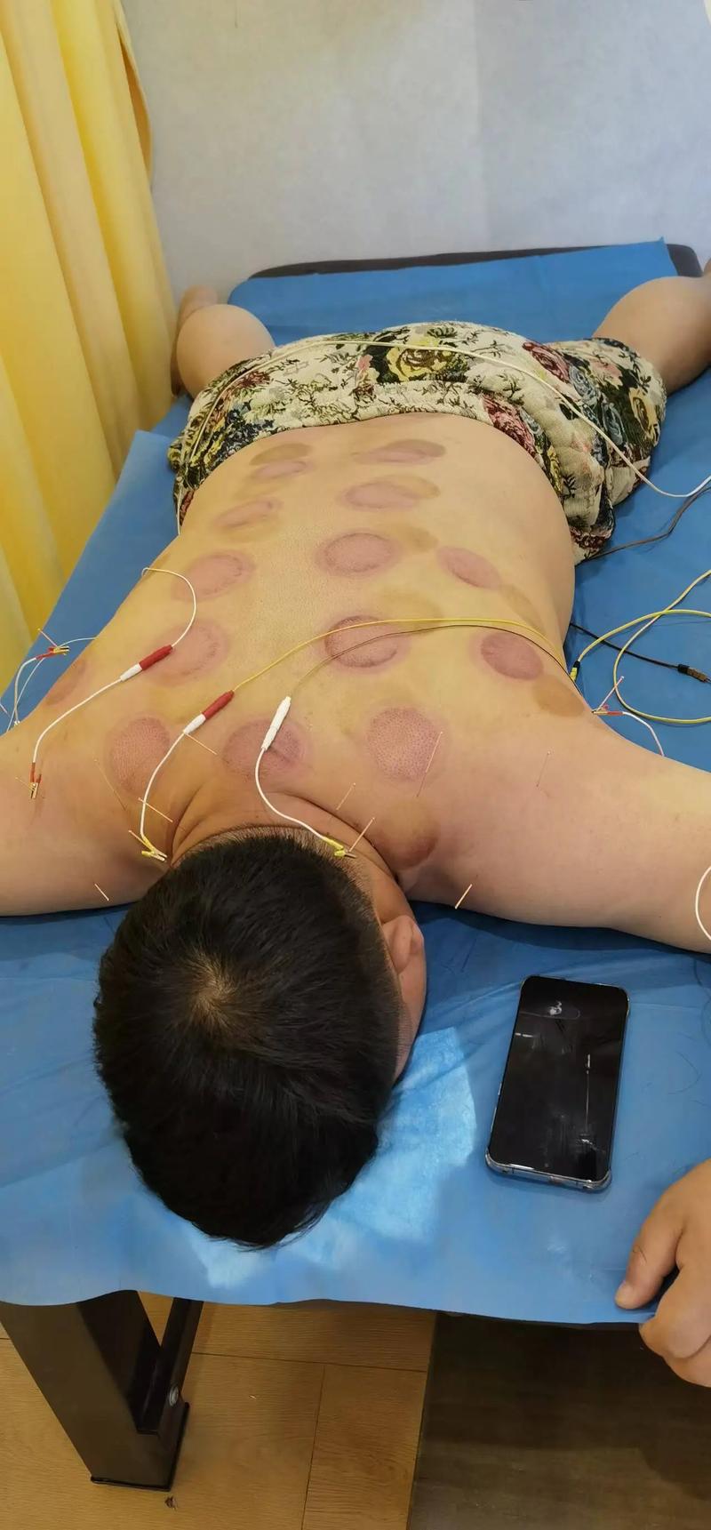 为什么针灸后会出汗多