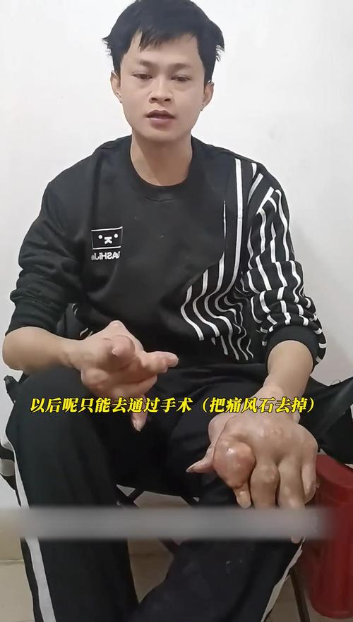 手上长满痛风石怎么办