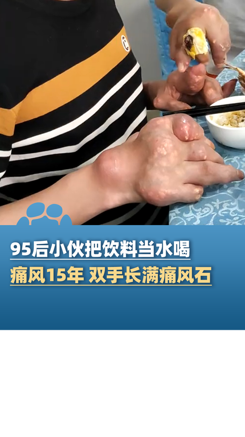 手上长满痛风石怎么办
