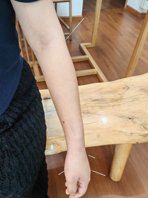 尿酸高针灸效果怎么样