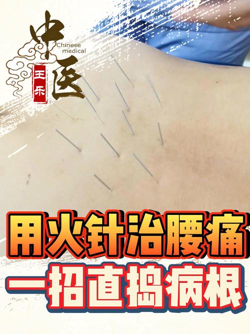 针灸腰部后反而更酸了