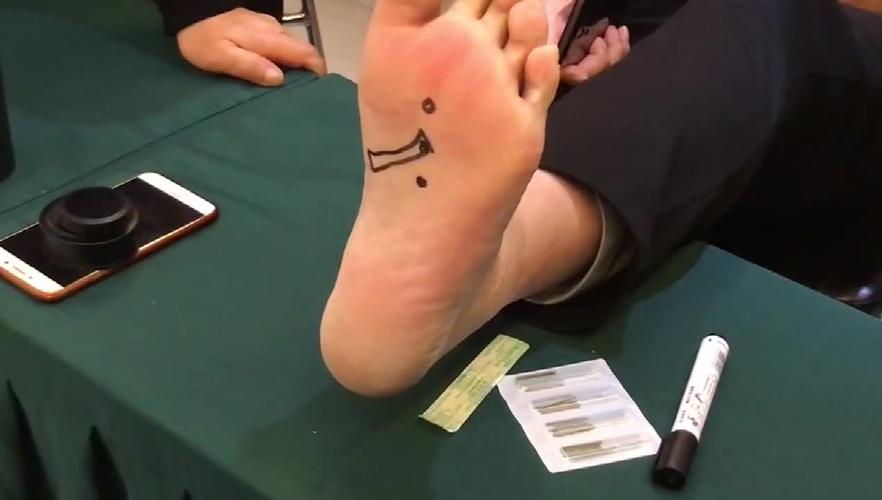 针灸扎脚心视频在线看