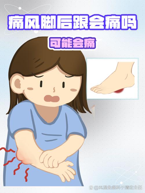 痛风会引起血小板低吗