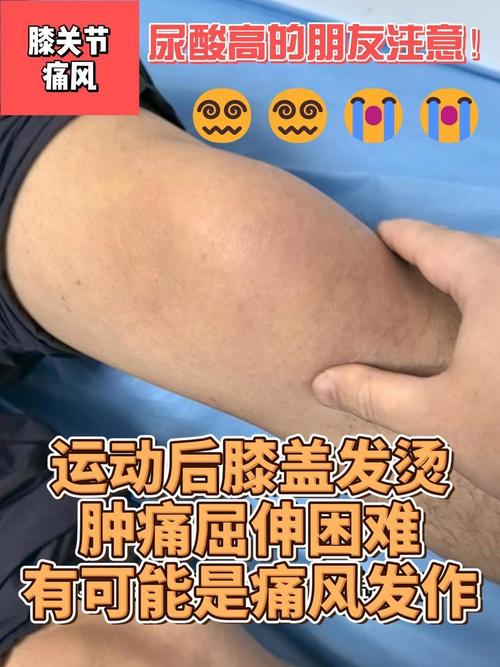 运动过量导致痛风发作