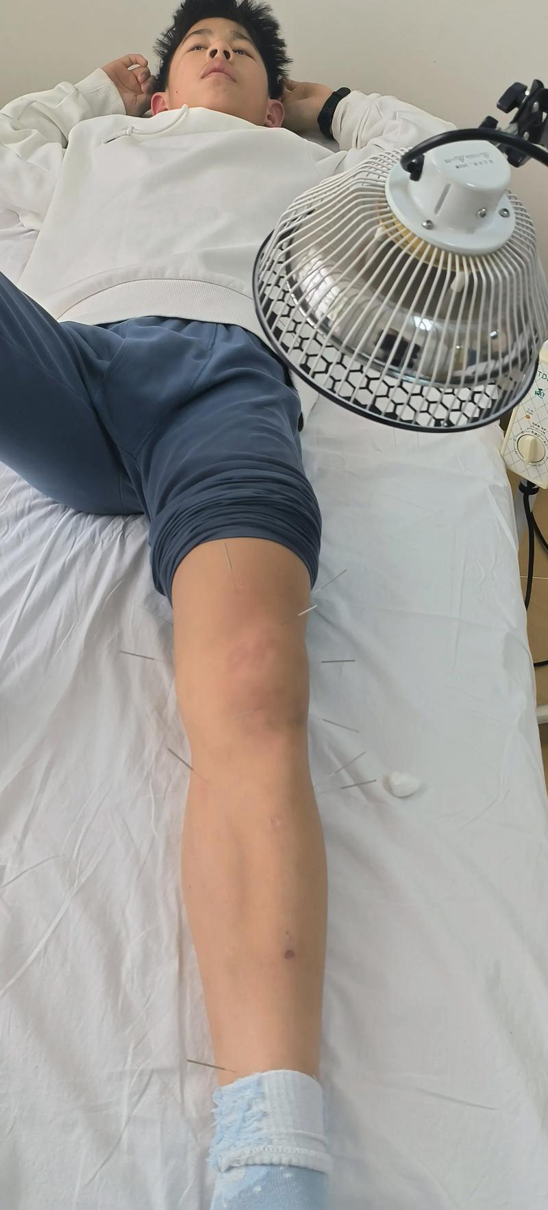 针灸治滑膜炎能去根吗