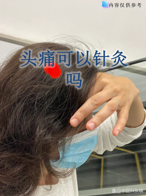 针灸治疗偏头痛的体会