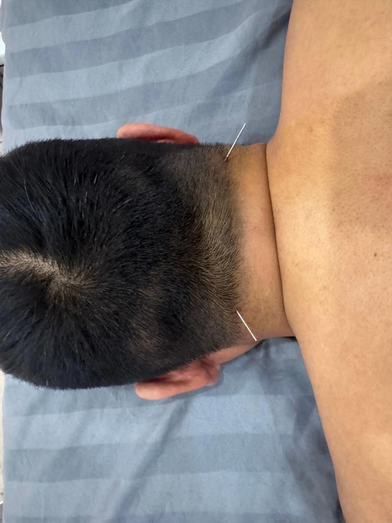 针灸治疗肾虚有效果吗