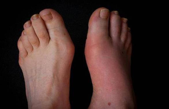 18岁的痛风能活多久