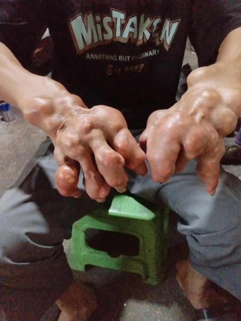 18岁的痛风能活多久