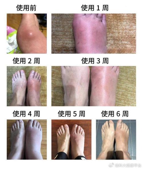 痛风和骨质增生的区别