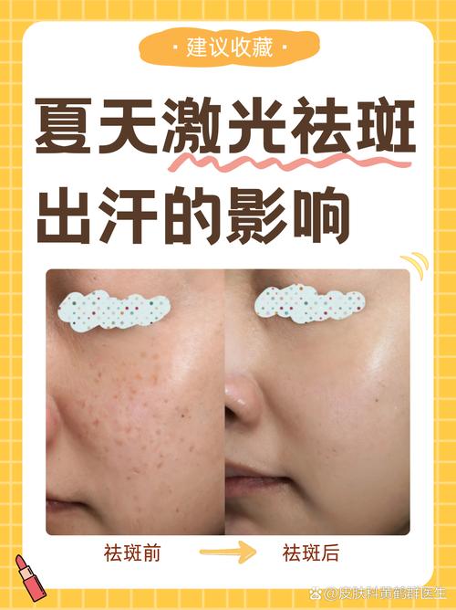 脸部做激光祛斑安全吗