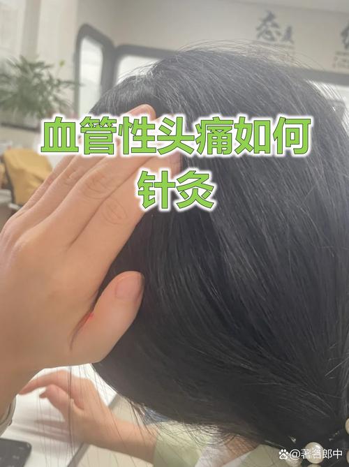 血管性头痛可以针灸吗