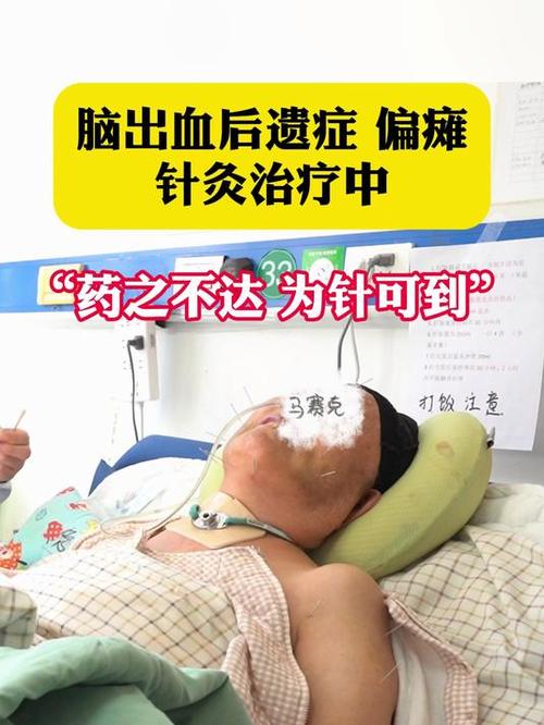 针灸治疗脑血栓后遗症