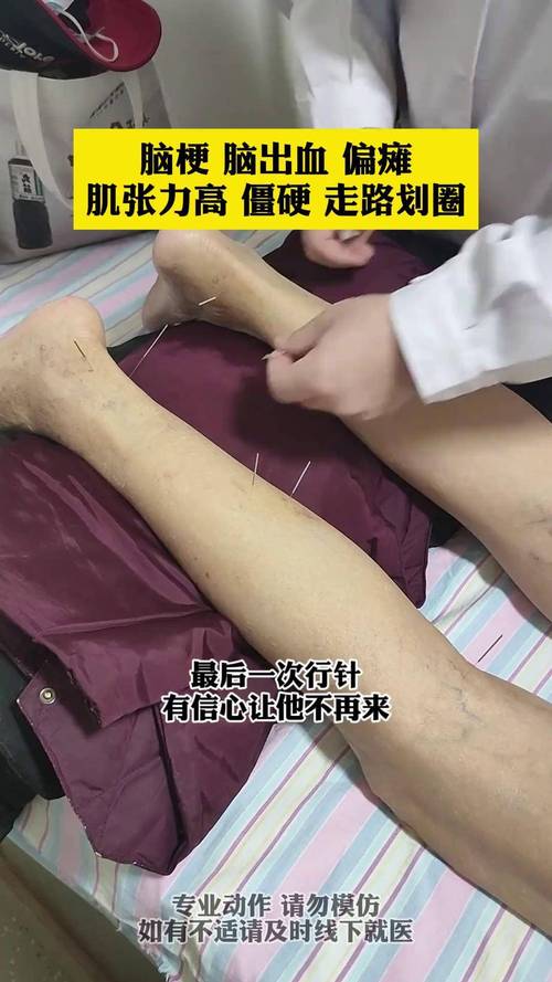 针灸治疗脑血栓后遗症