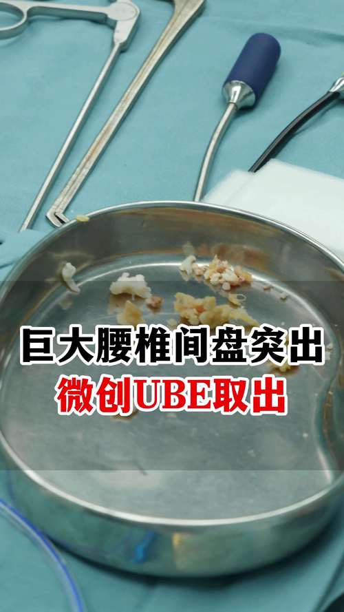 腰椎盘突出手术安全吗