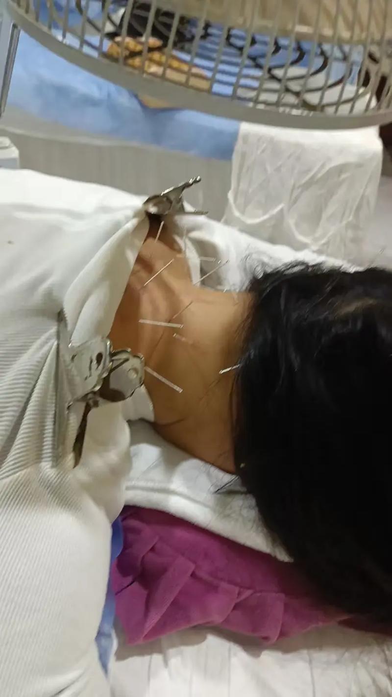 针灸能调理好激素脸吗