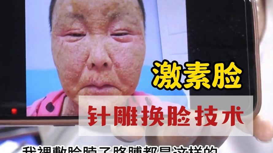 针灸能调理好激素脸吗