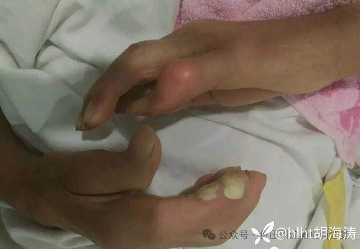 痛风是需要住院治疗吗