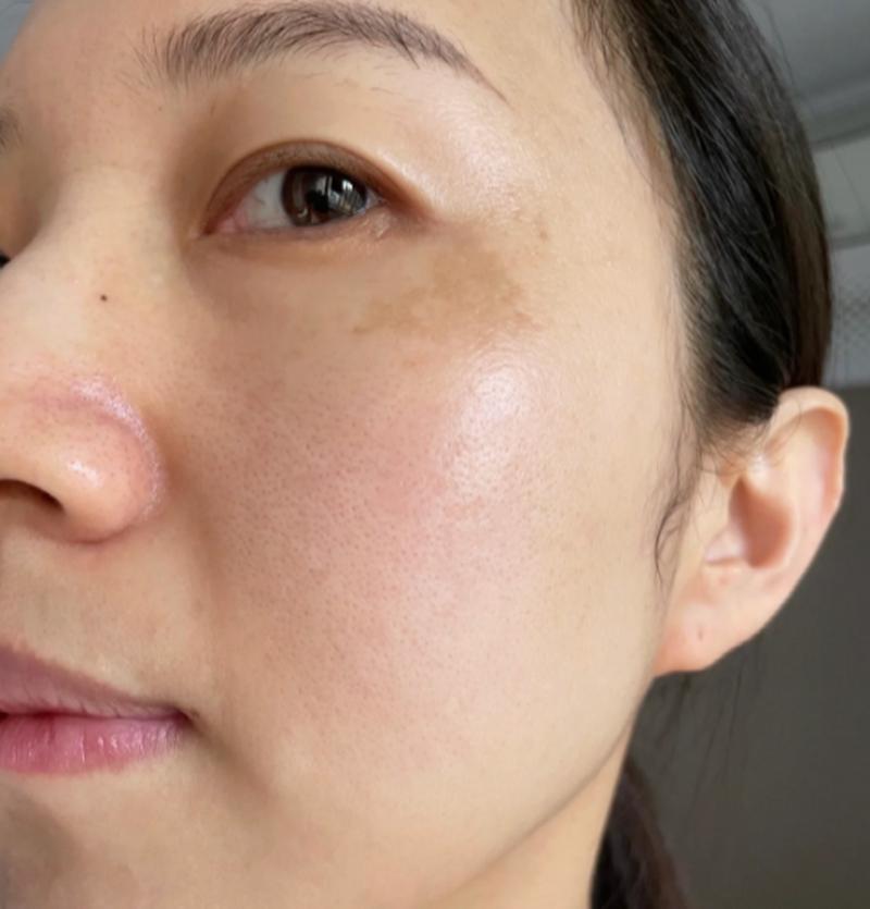 激光祛除黄褐斑安全吗