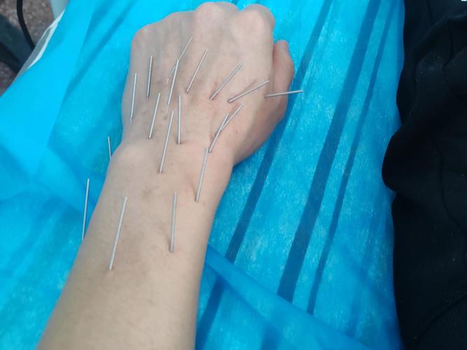 扎针灸的痛苦视频播放