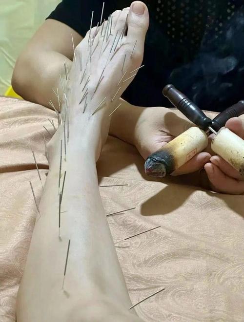 扎针灸的痛苦视频播放