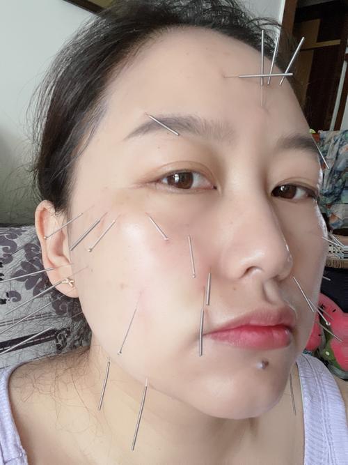 面部美容针灸扎的图片