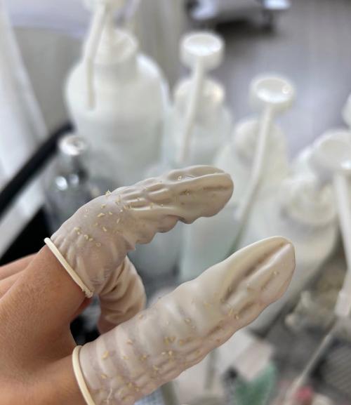 痤疮针灸怎么治疗方法