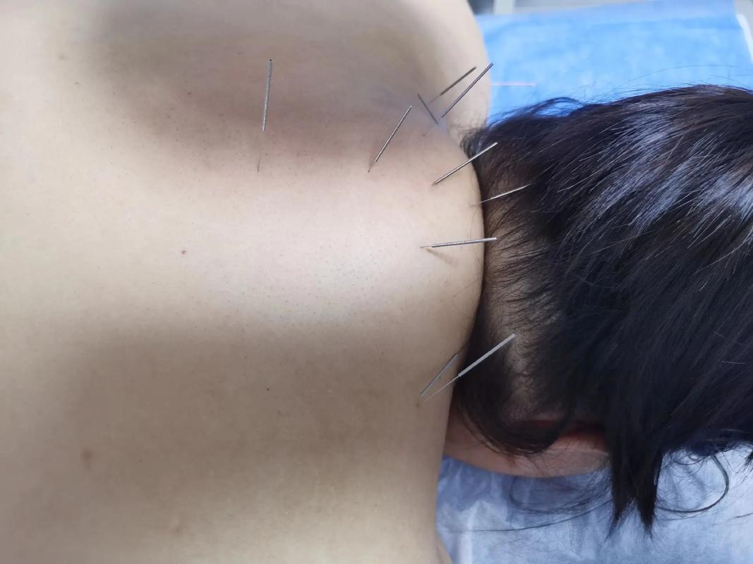 乳腺囊肿针灸能治好吗