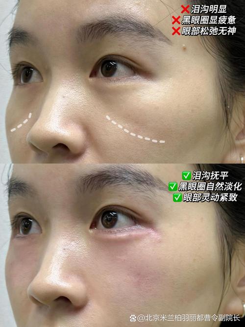 泪沟注射玻尿酸安全吗