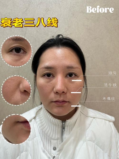 泪沟注射玻尿酸安全吗