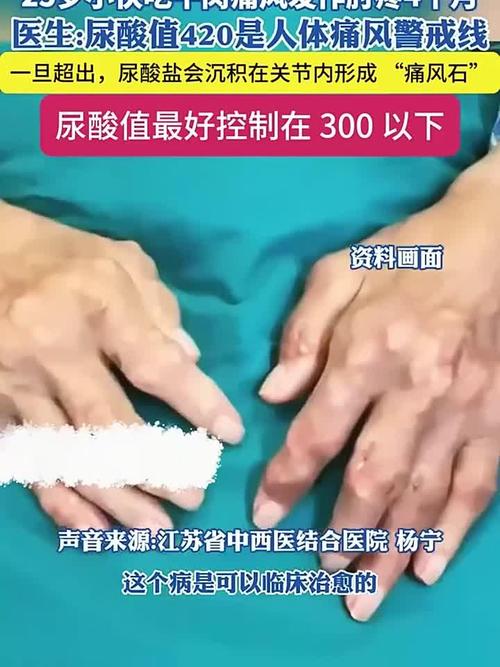 男朋友25岁就痛风了