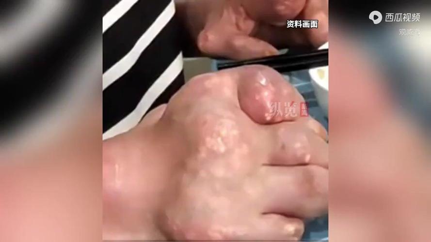 男朋友25岁就痛风了