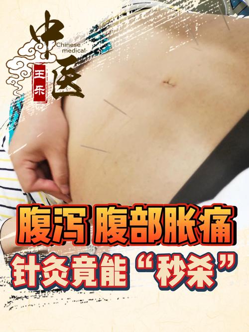 针灸调理肠胃功能絮乱