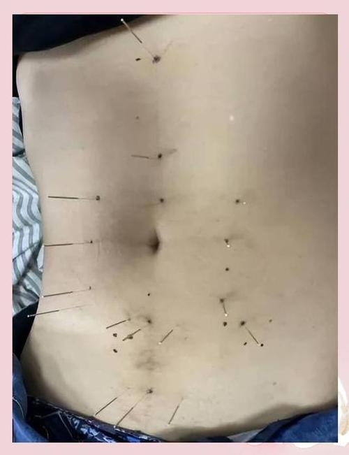 针灸调理肠胃功能絮乱