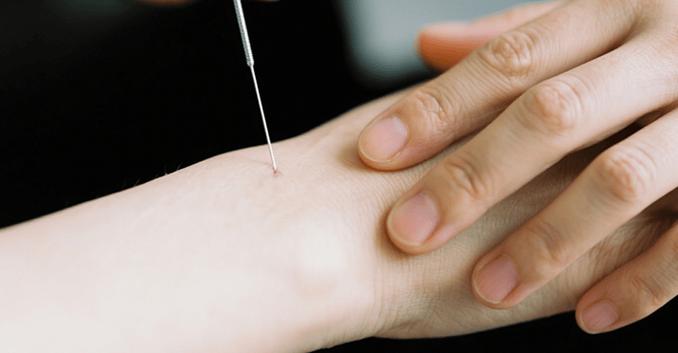 针灸晕针的话会死人吗