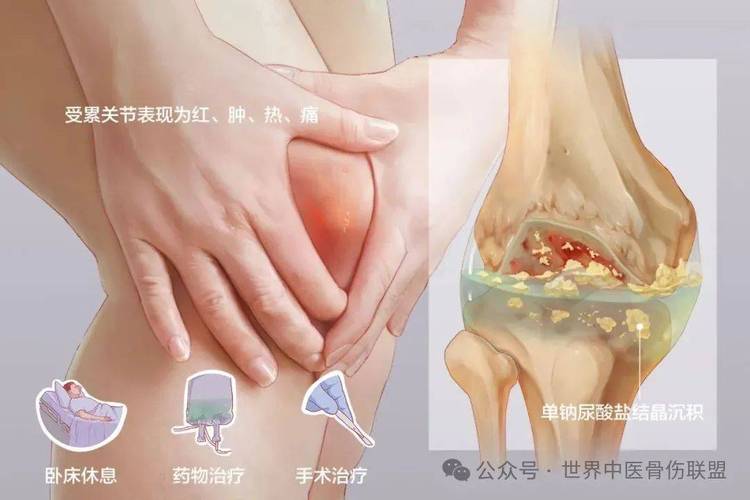 痛风引发的膝关节疼痛