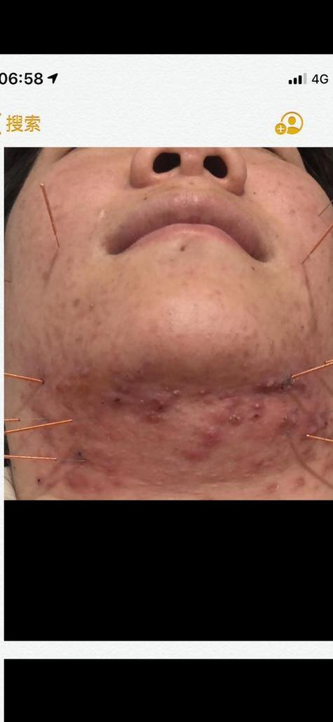 针灸放血能治疗痤疮吗