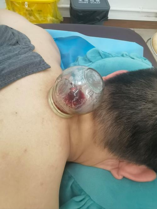 针灸放血能治疗痤疮吗