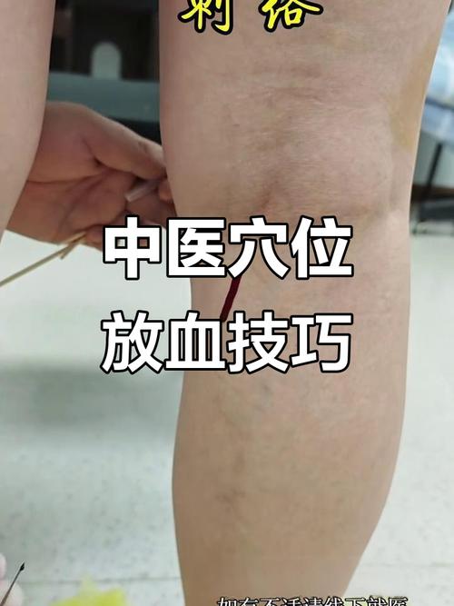 针灸放血能治疗痤疮吗