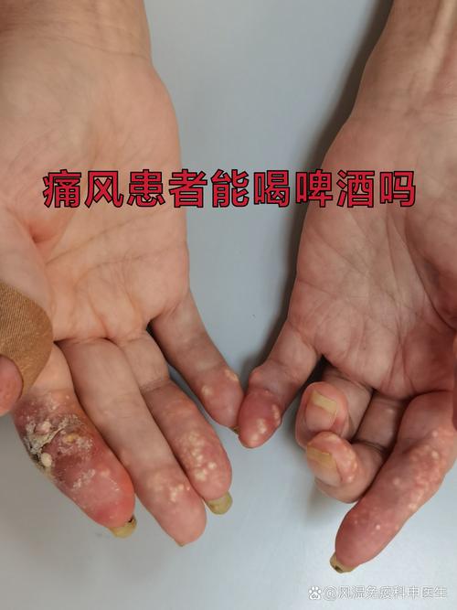 得了痛风可以喝可乐吗