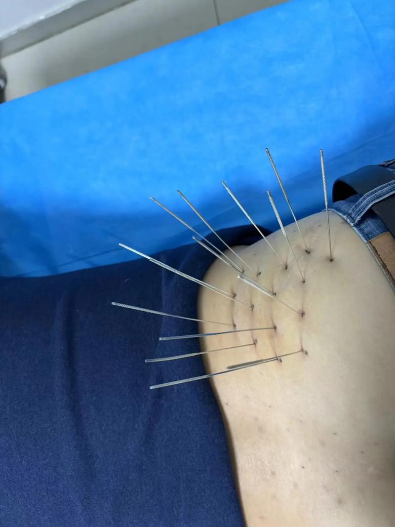 银针针灸可以治什么病