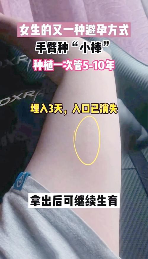 胳膊上埋线避孕安全吗
