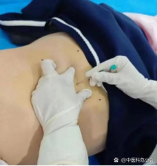 胳膊上埋线避孕安全吗