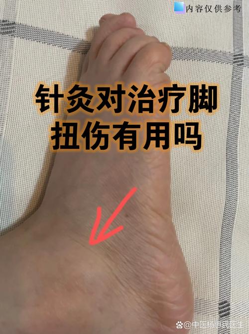 脚扭伤针灸有没有作用