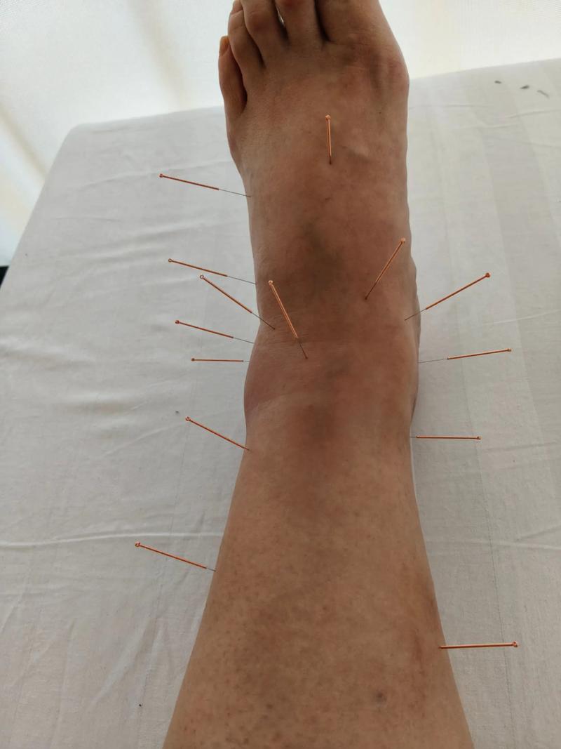 脚扭伤针灸有没有作用