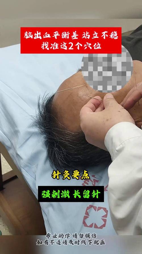 脑出血针灸越早越好吗