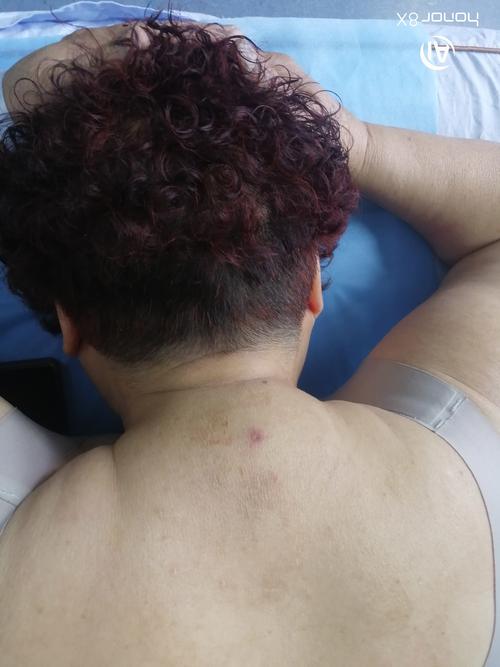 针灸断针后有什么症状