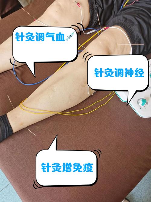 针灸治疗不孕不育原理