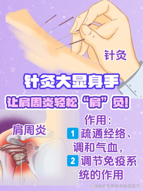 肩周炎用针灸治疗行吗